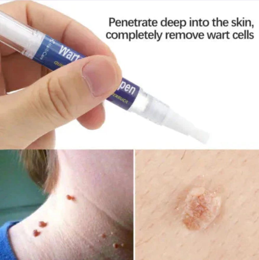 Warts Remover Original Cream